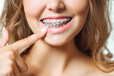 Braces for Teens: Common Questions Answered