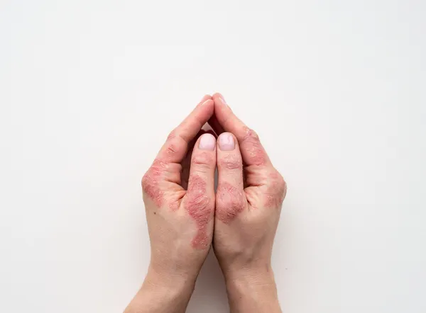 What Are the Latest Biologic Treatments for Severe Eczema