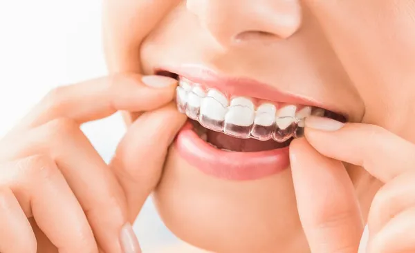 Facts About Invisalign You Need to Know