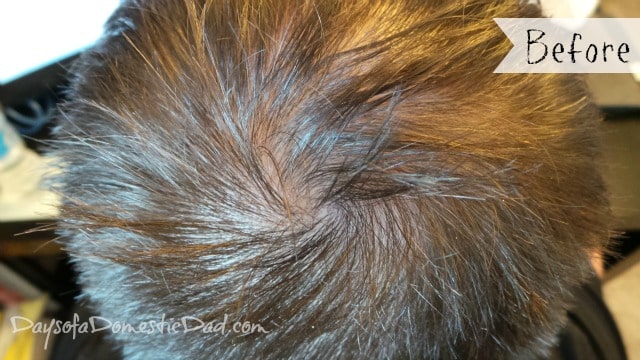 thinning hair - Does Viviscal work for male pattern baldness? Like most men dealing with hair loss, I too have my fair share of embarrassing and diminishing hair atop my head.